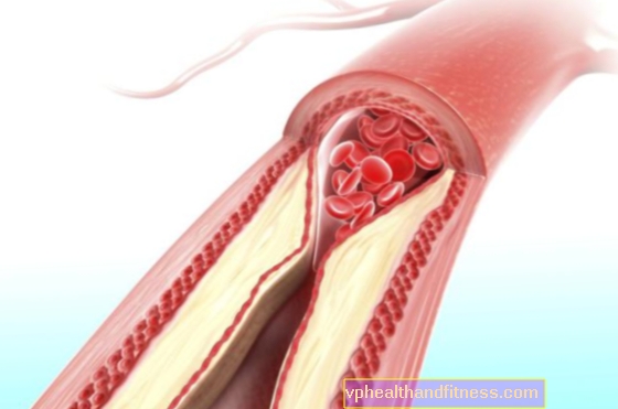 24 September - Hari Kesedaran Hiperkolesterolaemia Keluarga