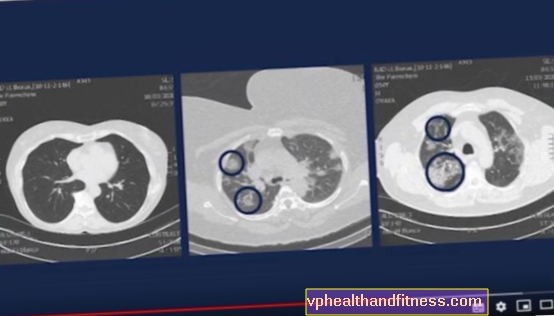 Zdravnik pokaže, kako koronavirus mladim uničuje pljuča