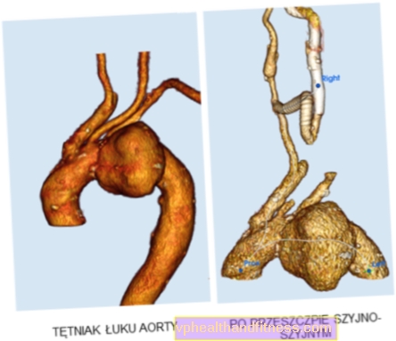 Cirugía innovadora del aneurisma del arco aórtico en el Centro Clínico Universitario de la Universidad Médica de Varsovia