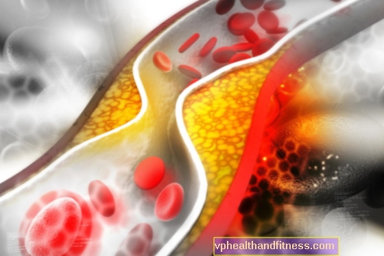 La remisión de la aterosclerosis es posible