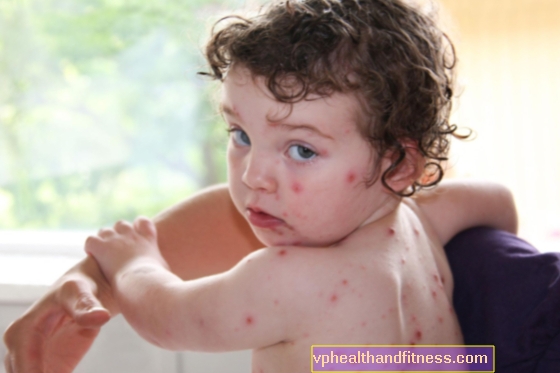 Varicela en un niño. Síntomas y tratamiento de la viruela en niños.