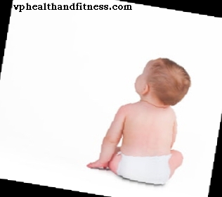 Flat head syndrom eller plagiocephaly