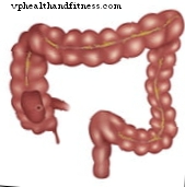 Sigmoiditis eller diverticulitis symptomer