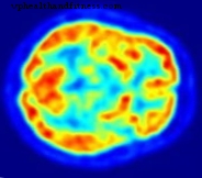 早期腎癌を予測および予測するタンパク質を特定する