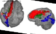 Quase metade das crianças com paralisia cerebral na Espanha sofre dor