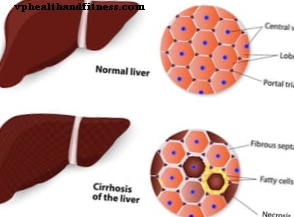 Kas yra kepenų cirozė