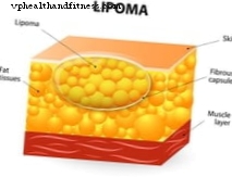 Lipoma: simptomi, diagnostika un ārstēšana