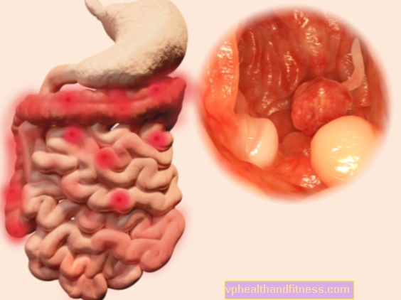 Kanker usus besar. Lakukan riset agar Anda tidak terkejut dengan kanker usus besar