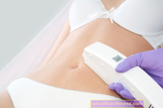 Dermabrasion et laser pour les vergetures