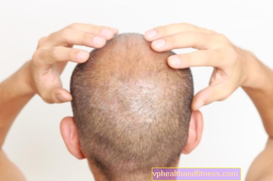 Alopecia androgenética: un problema masculino. Causas, síntomas de la alopecia androgenética.