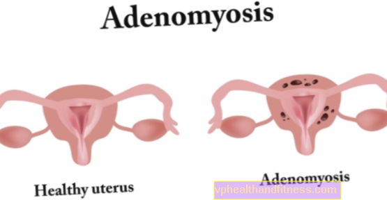 Adenomioze: cēloņi, simptomi, ārstēšana