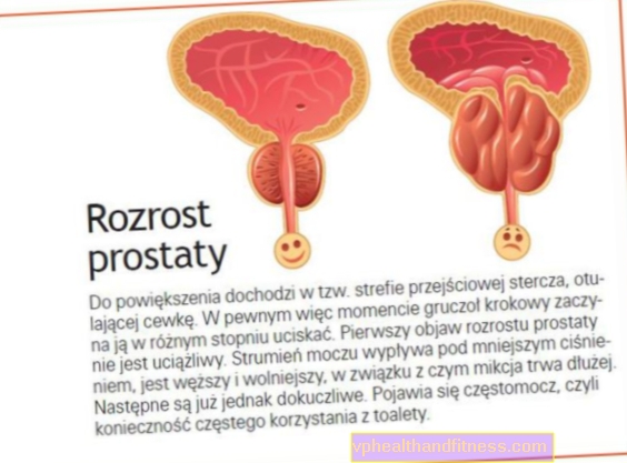 Hiperplasia prostática benigna: tratamiento