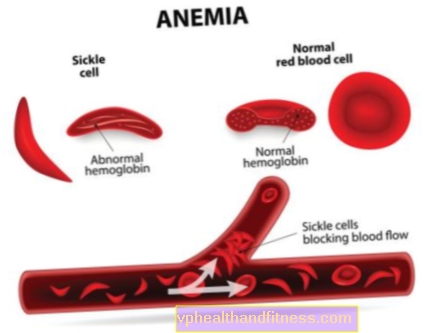 Anemia: falta de hierro. Síntomas y causas de la anemia