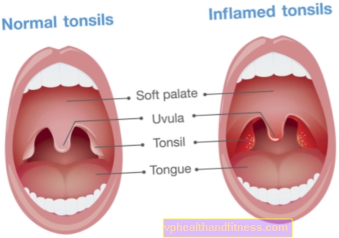 Angina: cause, sintomi, trattamento