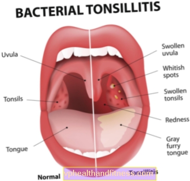 Angina purulenta: causas, sintomas, tratamento