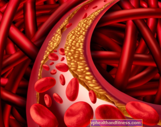 Atherectomy : 유형, 적응증, 코스, 합병증