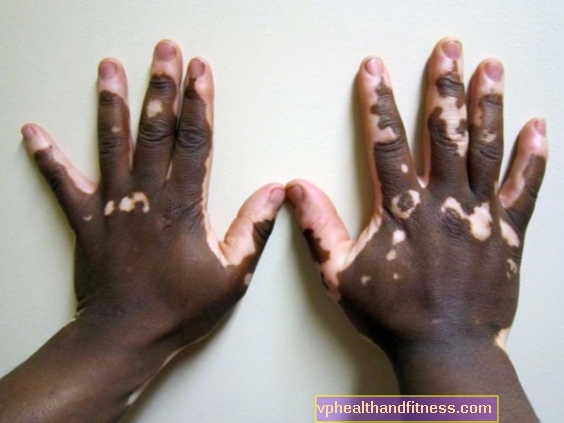 Vitiligo - cēloņi, simptomi, ārstēšana