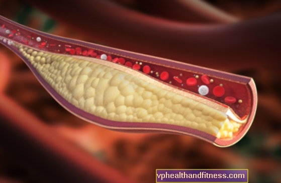 Атеросклеротични плак - како настаје? Симптоми, лечење