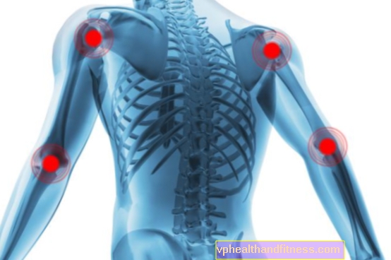 Condrocalcinosis (seudogota): causas, síntomas, tratamiento