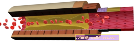 Enfermedad de Buerger o trombosis arterial