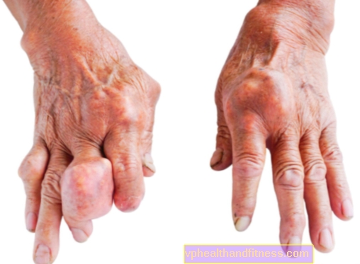 Gout (gout, arthritis): penyebab, gejala, pengobatan