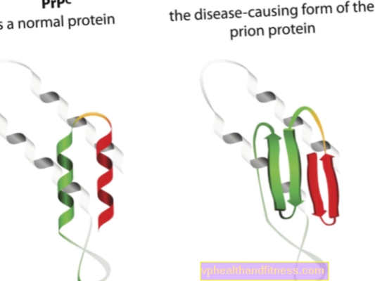 Ensefalopati spongiform: penyakit prion misterius