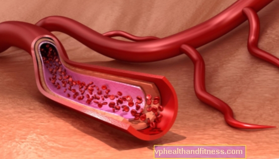 Eozinofil granulomatózis polyangiitissel (Churg-Strauss szindróma)