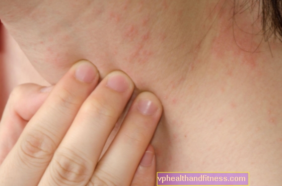 Eritrodermia o dermatitis exfoliativa