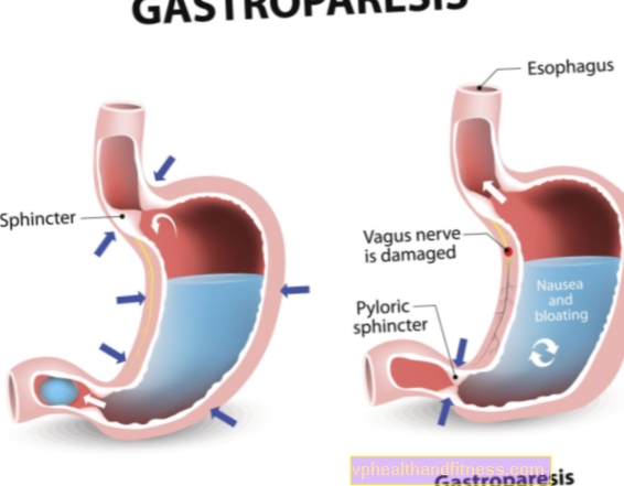 Gastropareesi: syyt, oireet, hoito