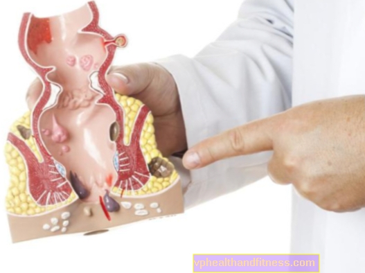 Hemorroides anales: causas, síntomas, tratamiento.