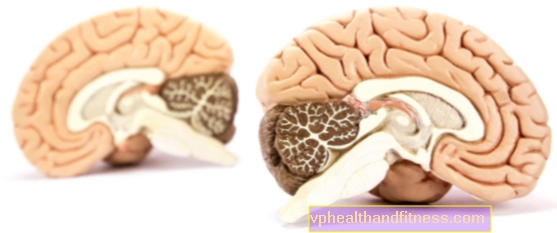 Tumores cerebelosos: causas, síntomas, tratamiento.