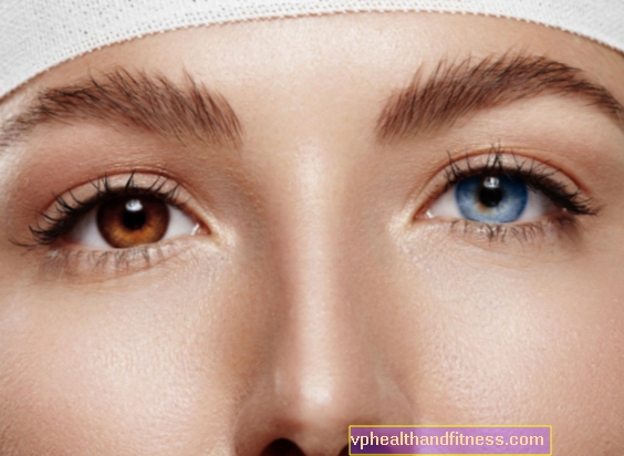 HETEROCHROMIA, es decir, los iris de diferentes colores del ojo