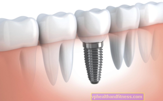 ¿Cómo se colocan los implantes dentales?