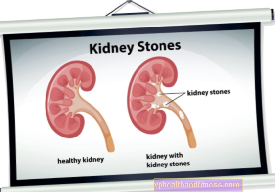 Nefrolithiasis - årsaker, symptomer, behandling