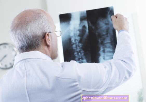 Sarcoma de Ewing (tumor): causas, síntomas, tratamiento y pronóstico