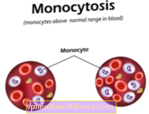 Monositoz: nedenleri. Fazla monosit tehlikeli midir?