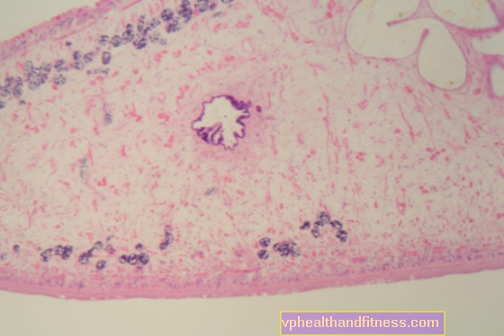 Micosis y fasciolosis hepática: síntomas, tratamiento y diagnóstico