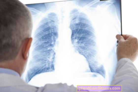 Hipertensi pulmonal: penyebab, gejala, pengobatan