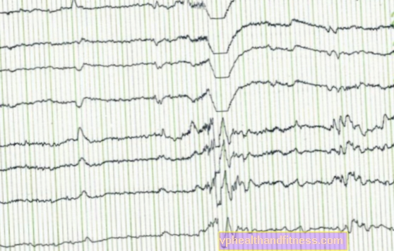 Epileptische aanval - wat te doen bij een epileptische aanval? Hoe kan ik helpen bij een aanval?