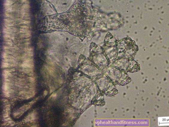 Demodex y Demodex. Síntomas, examen y tratamiento de la demodecosis.