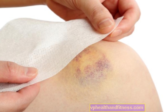 Primeros auxilios para hematomas. ¿Qué hacer si se lesiona una pierna o un brazo?