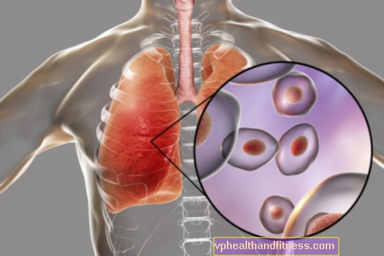 Пневмоцистозна пневмонія (пневмоцистоз): причини, симптоми, лікування
