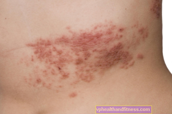 Psoriasis - types, diagnostic, traitement