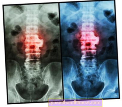 Spondylose og spondyloarthrose - degeneration af rygsøjlen og intervertebrale led