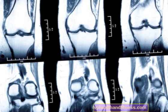 Mieloma múltiple (enfermedad de Kahler): un cáncer de la médula ósea