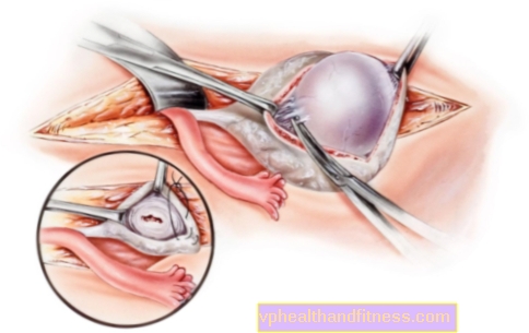 Quiste dérmico ovárico: causas, síntomas, tratamiento