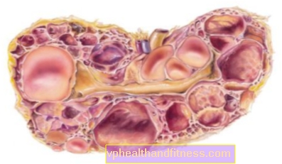 Ciste na bubrezima: uzroci, simptomi, vrste, liječenje