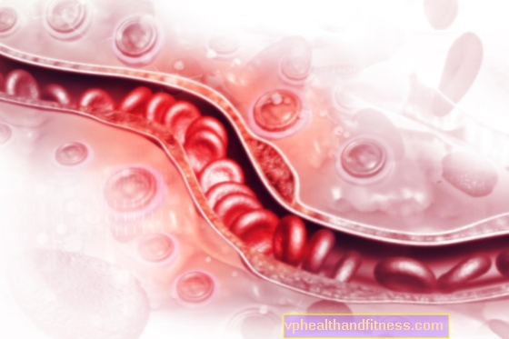 Trombectomia meccanica: indicazioni, decorso, complicanze