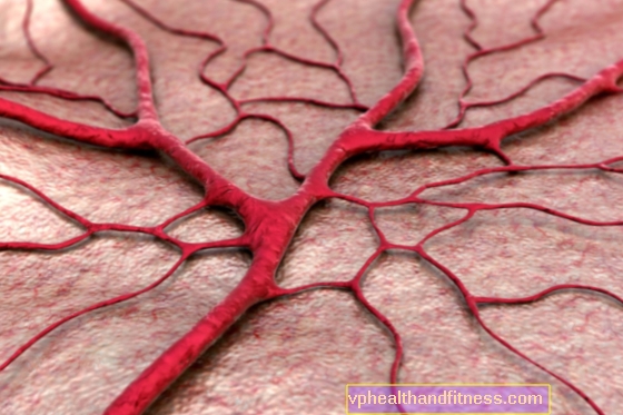 Aneurisma: causas, síntomas y tratamiento de los aneurismas