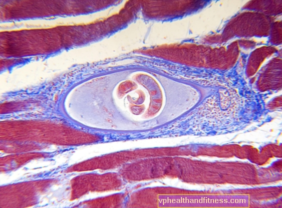 Triquinelosis: causas, síntomas, tratamiento